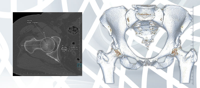 Imagem Impacto Femoroacetabular