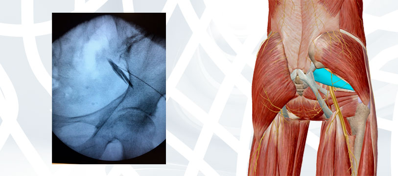 Imagem Sindrome do Gluteo Profundo